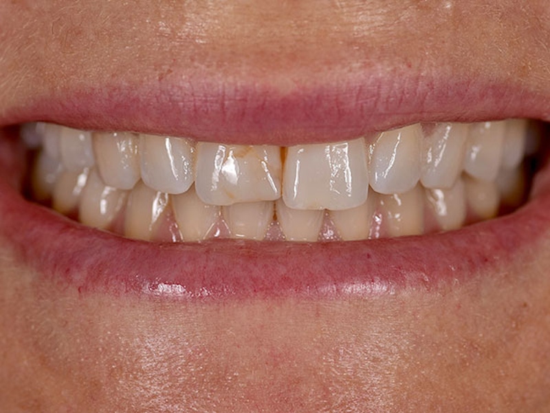 Smile Makeover Closeups Before & After Gallery - Patient 186106822 - Image 1