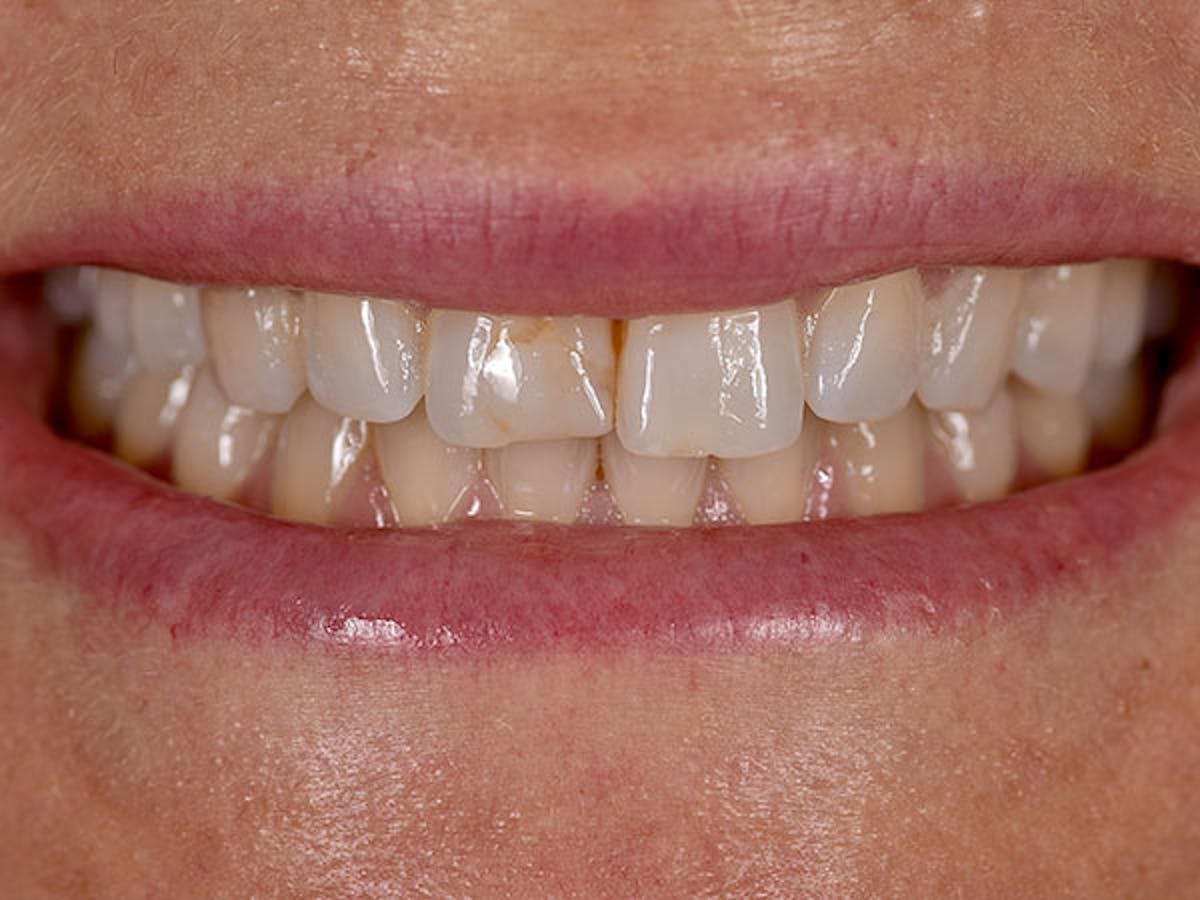 Smile Makeover Closeups Before & After Gallery - Patient 186106822 - Image 1