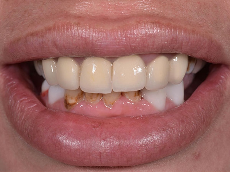 Smile Makeover Closeups Before & After Gallery - Patient 186106823 - Image 1