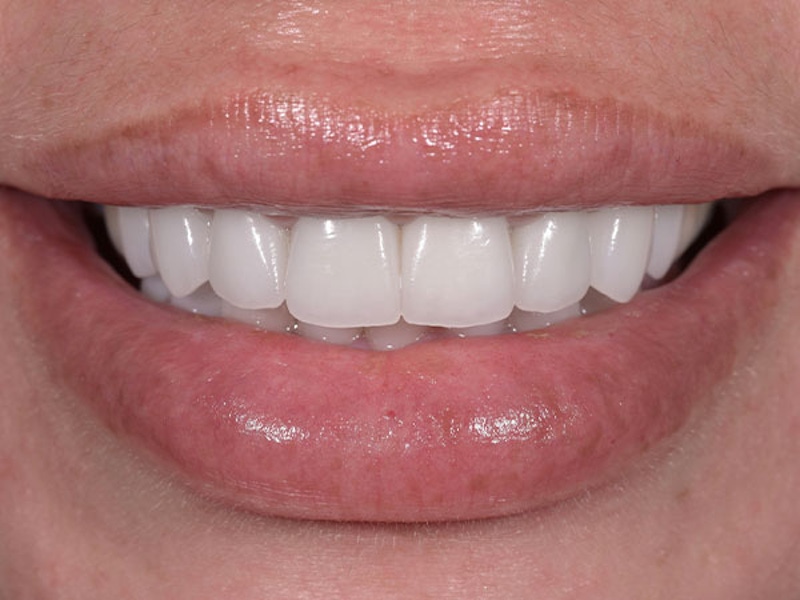 Smile Makeover Closeups Before & After Gallery - Patient 186106823 - Image 2