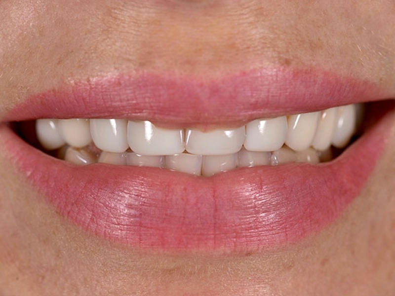 Smile Makeover Closeups Before & After Gallery - Patient 186106824 - Image 1
