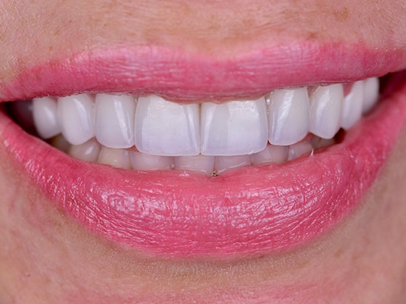 Smile Makeover Closeups Before & After Gallery - Patient 186106824 - Image 2