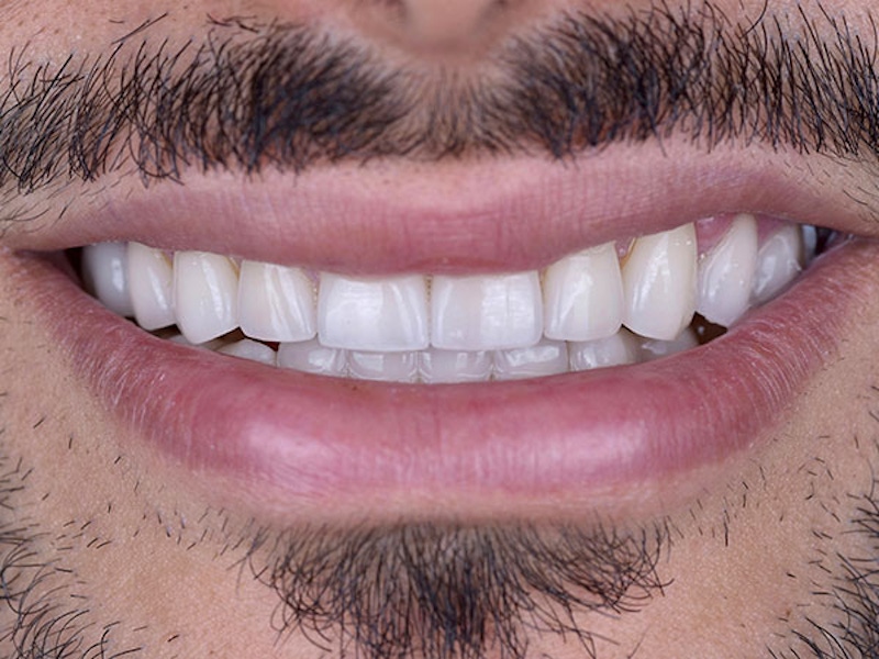 Smile Makeover Closeups Before & After Gallery - Patient 186106825 - Image 1