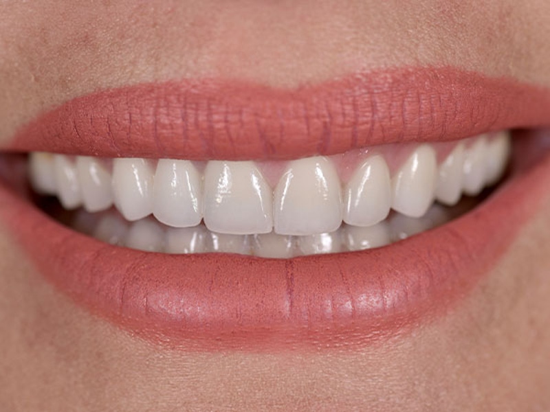 Smile Makeover Closeups Before & After Gallery - Patient 186106826 - Image 2