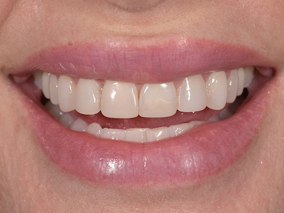 Smile Makeover Closeups Before & After Gallery - Patient 186106827 - Image 1