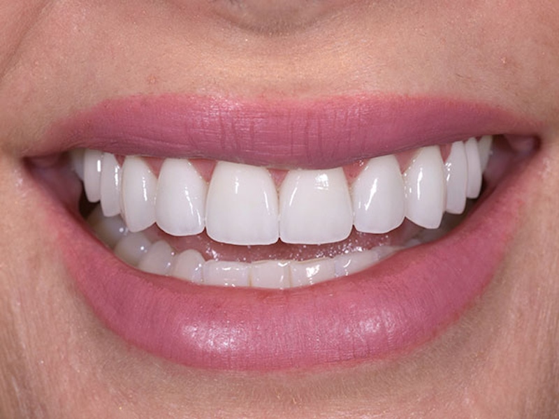 Smile Makeover Closeups Before & After Gallery - Patient 186106827 - Image 2
