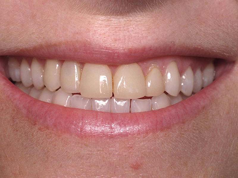 Smile Makeover Closeups Before & After Gallery - Patient 186106828 - Image 1
