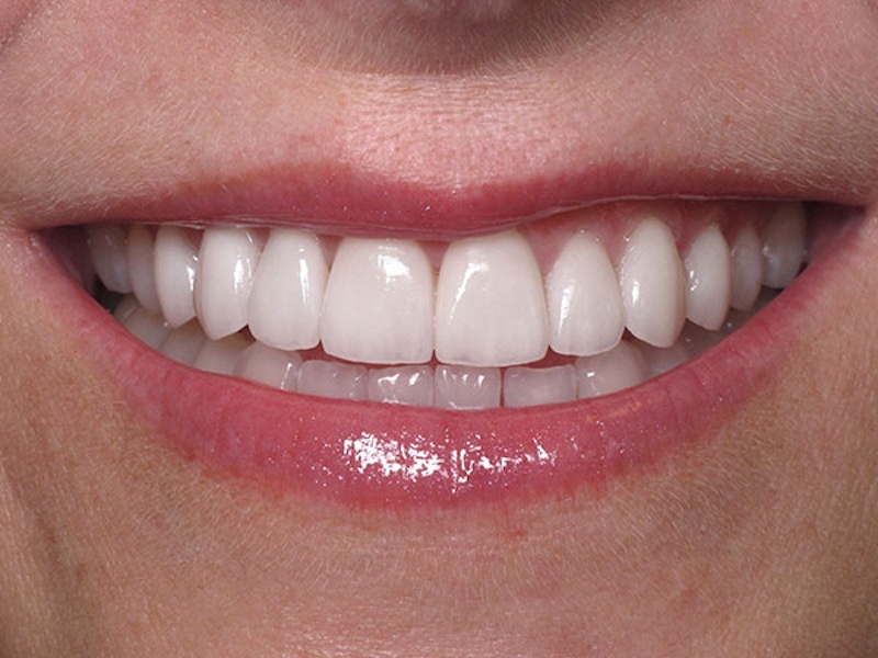 Smile Makeover Closeups Before & After Gallery - Patient 186106828 - Image 2