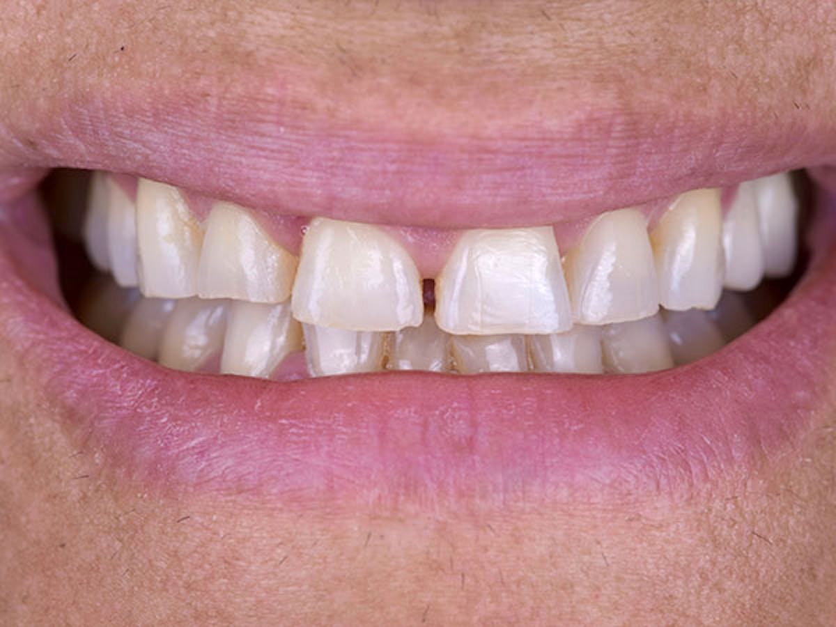 Smile Makeover Closeups Before & After Gallery - Patient 186106829 - Image 1