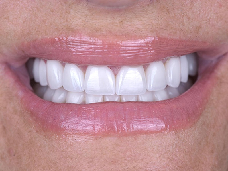 Smile Makeover Closeups Before & After Gallery - Patient 186106829 - Image 2
