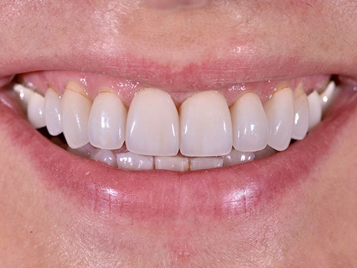 Smile Makeover Closeups Before & After Gallery - Patient 186106830 - Image 1