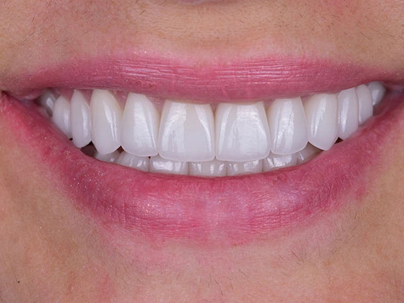 Smile Makeover Closeups Before & After Gallery - Patient 186106830 - Image 2