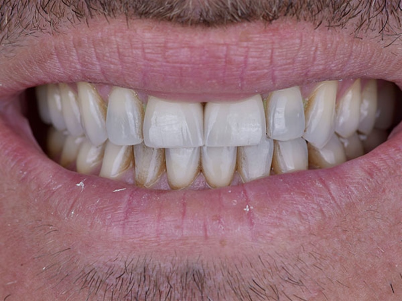 Smile Makeover Closeups Before & After Gallery - Patient 186106831 - Image 1