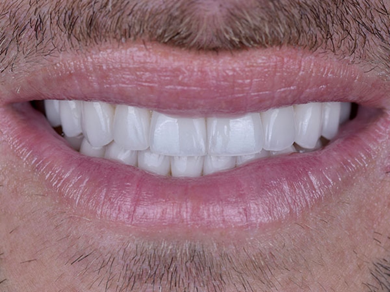 Smile Makeover Closeups Before & After Gallery - Patient 186106831 - Image 2
