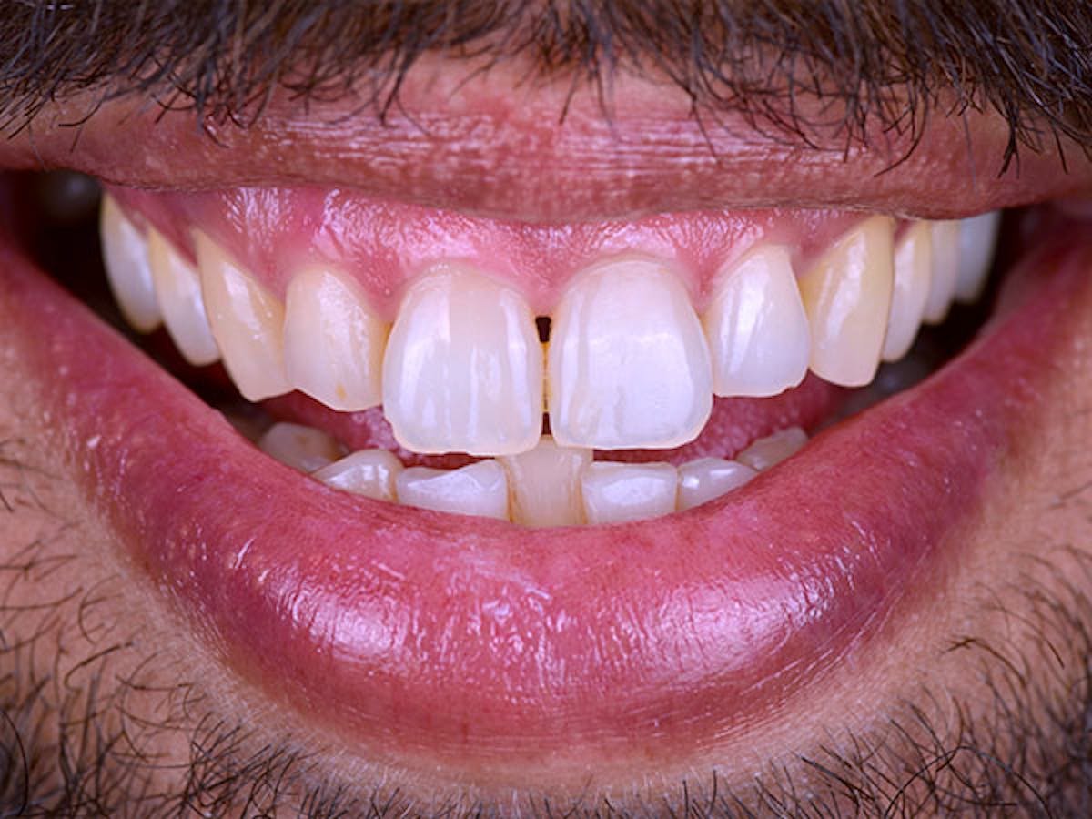 Smile Makeover Closeups Before & After Gallery - Patient 186106832 - Image 1