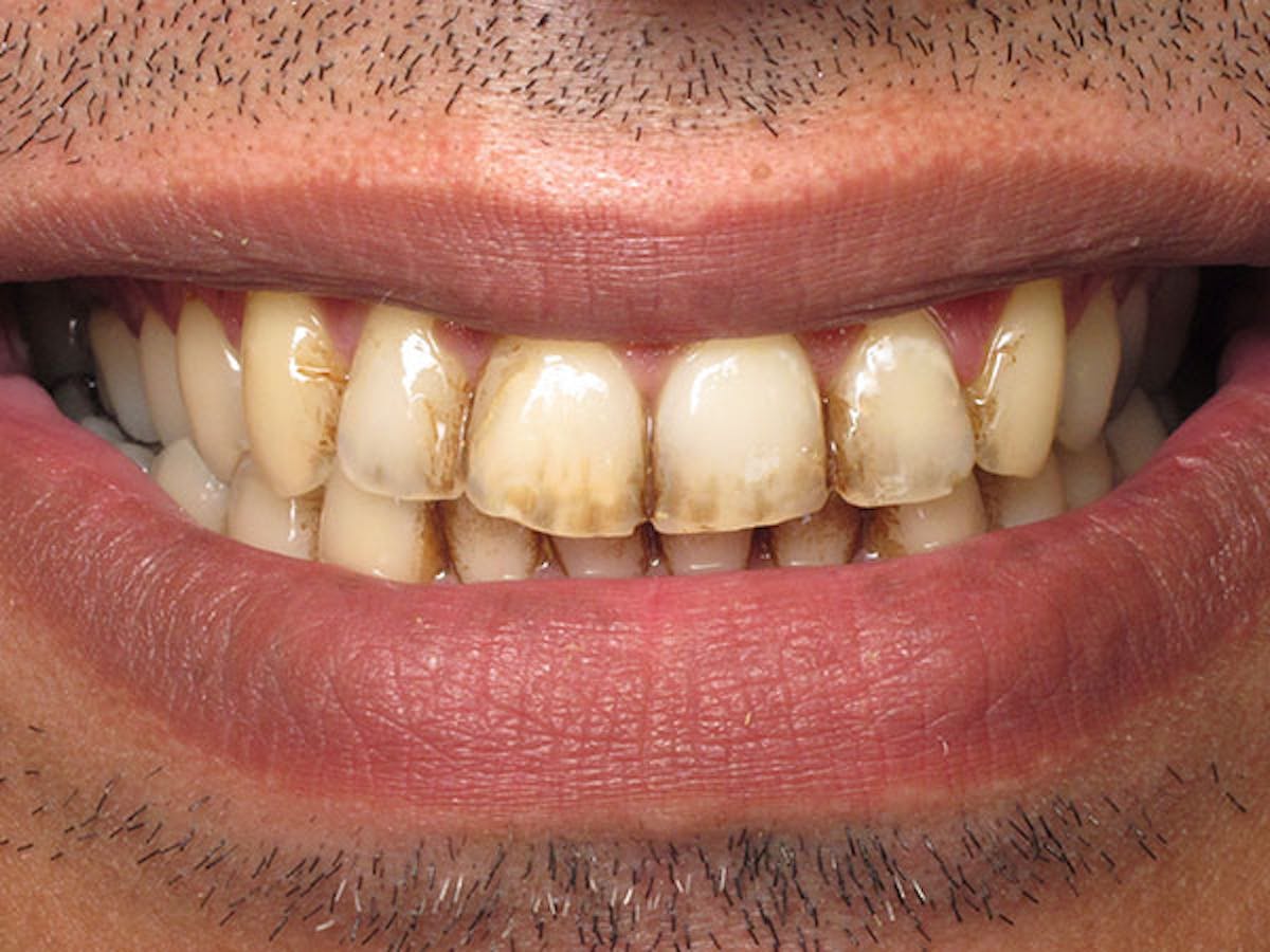 Smile Makeover Closeups Before & After Gallery - Patient 186106833 - Image 1
