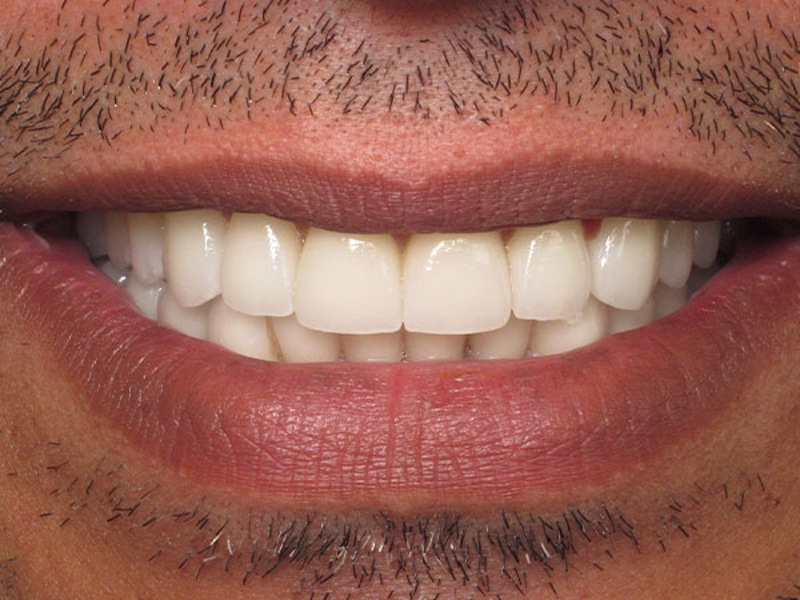Smile Makeover Closeups Before & After Gallery - Patient 186106833 - Image 2