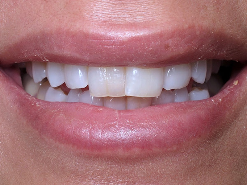 Smile Makeover Closeups Before & After Gallery - Patient 186106834 - Image 1