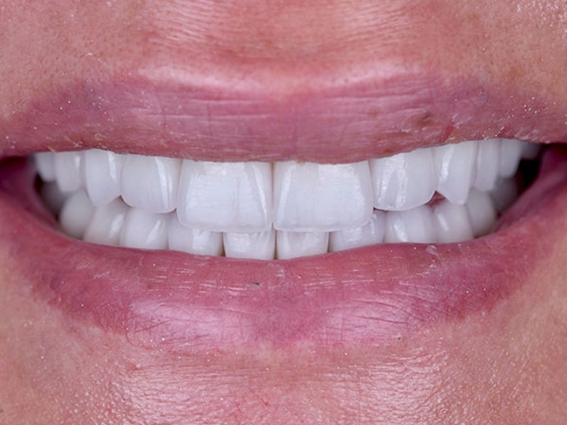 Smile Makeover Closeups Before & After Gallery - Patient 186106834 - Image 2