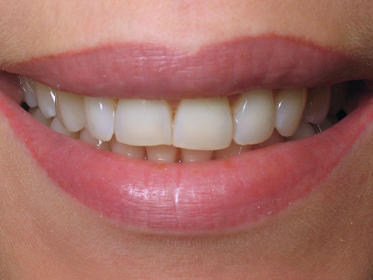 Smile Makeover Closeups Before & After Gallery - Patient 186106835 - Image 1