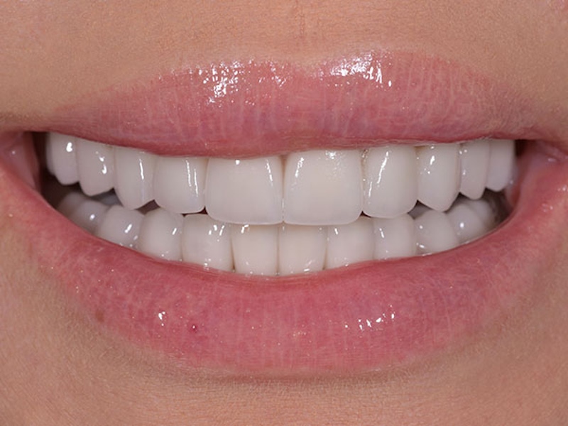 Smile Makeover Closeups Before & After Gallery - Patient 186106835 - Image 2