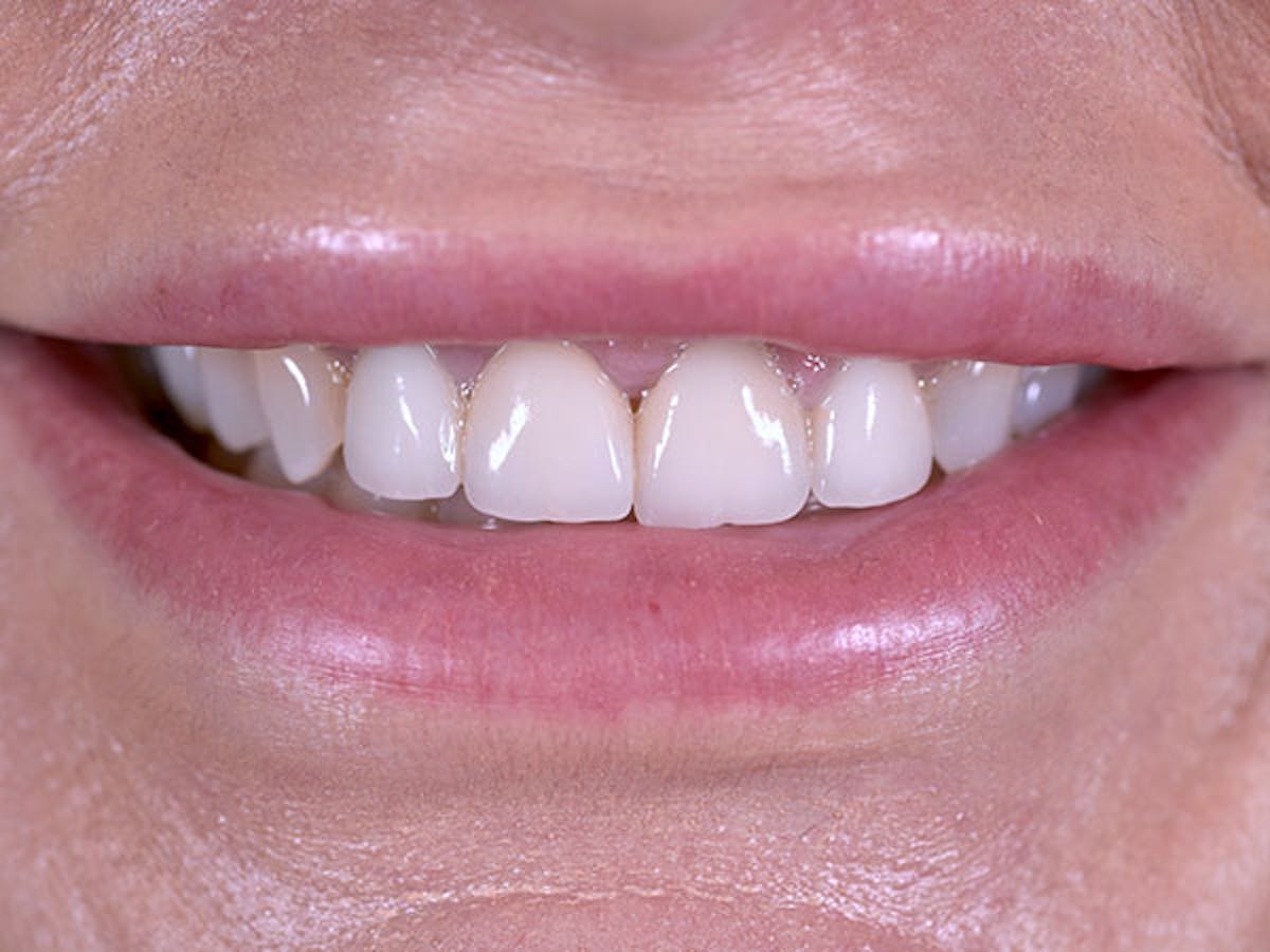Smile Makeover Closeups Before & After Gallery - Patient 186106836 - Image 1