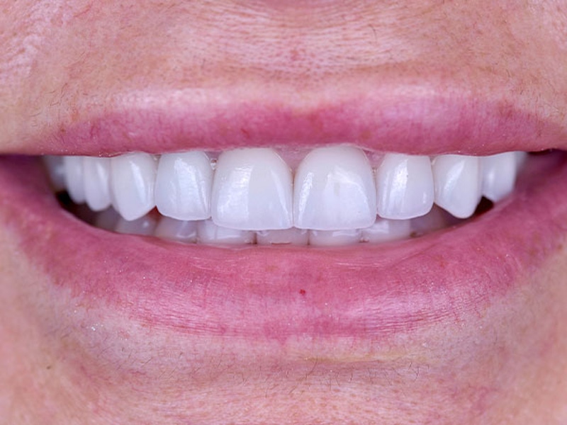 Smile Makeover Closeups Before & After Gallery - Patient 186106836 - Image 2