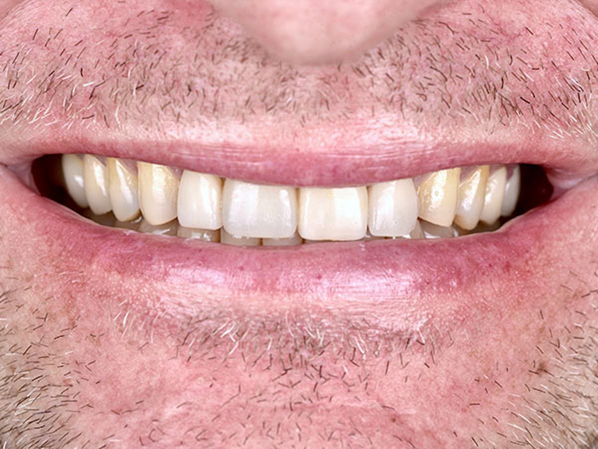 Smile Makeover Closeups Before & After Gallery - Patient 186106837 - Image 1