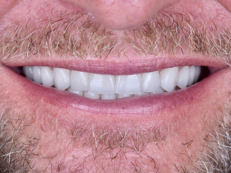 Smile Makeover Closeups Before & After Gallery - Patient 186106837 - Image 2