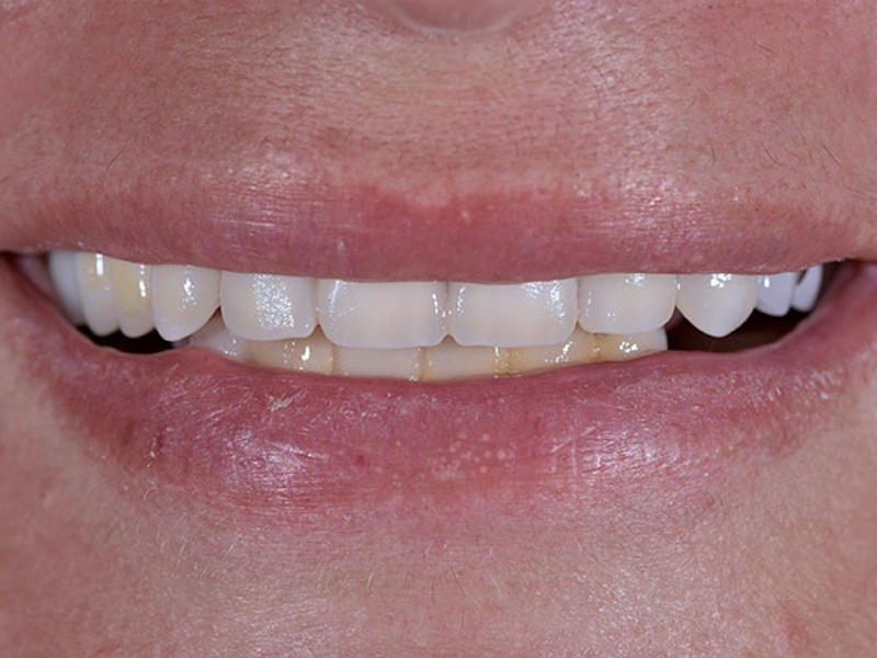 Smile Makeover Closeups Before & After Gallery - Patient 186106838 - Image 1