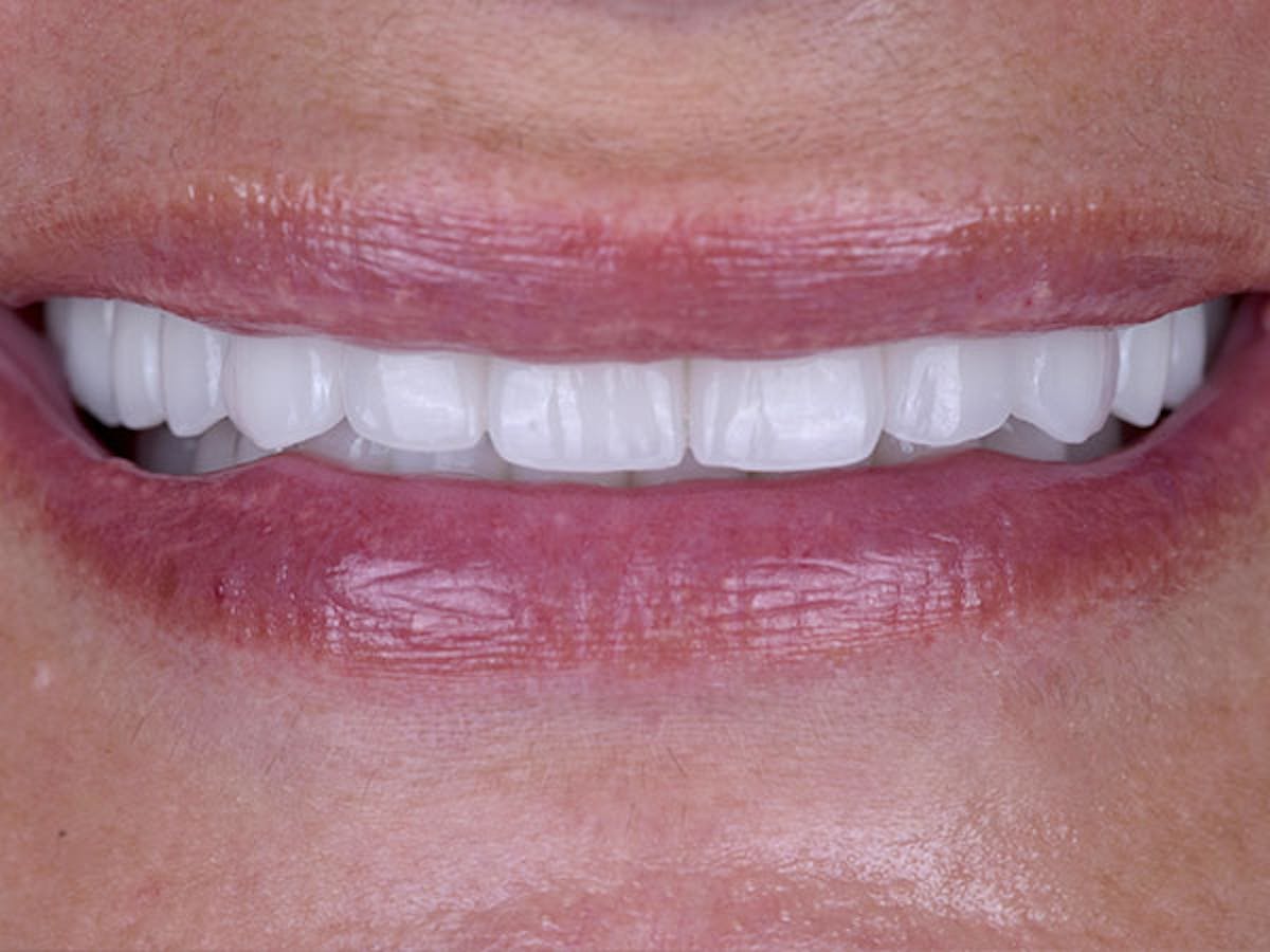 Smile Makeover Closeups Before & After Gallery - Patient 186106838 - Image 2