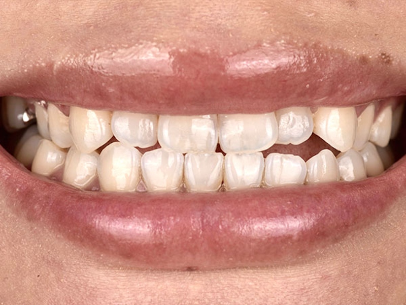 Smile Makeover Closeups Before & After Gallery - Patient 186106839 - Image 1