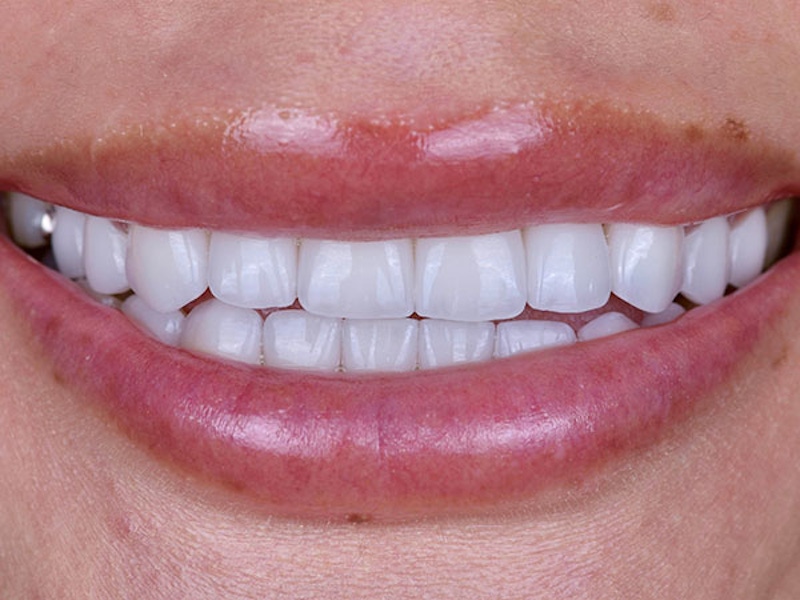 Smile Makeover Closeups Before & After Gallery - Patient 186106839 - Image 2