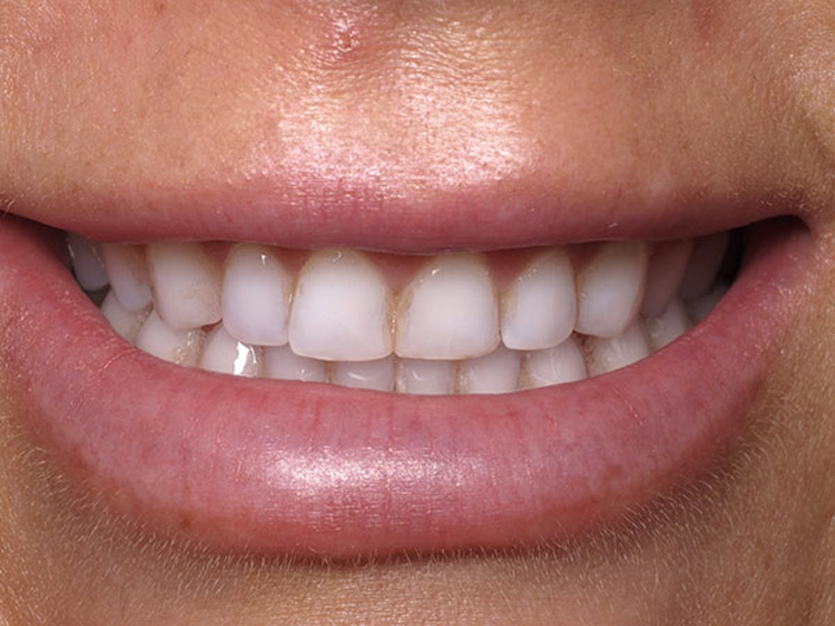 Smile Makeover Closeups Before & After Gallery - Patient 186106840 - Image 1