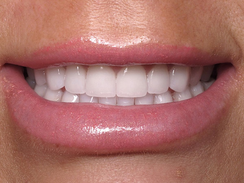 Smile Makeover Closeups Before & After Gallery - Patient 186106840 - Image 2