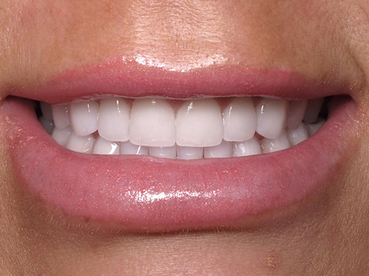 Smile Makeover Closeups Before & After Gallery - Patient 186106840 - Image 2