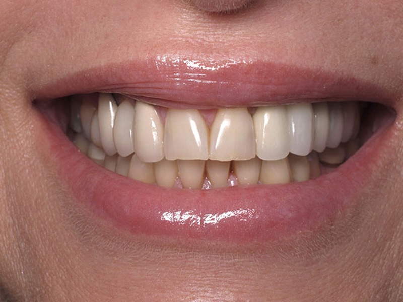 Smile Makeover Closeups Before & After Gallery - Patient 186106841 - Image 1