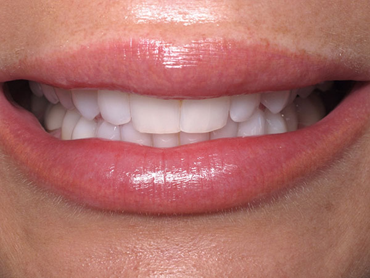 Smile Makeover Closeups Before & After Gallery - Patient 186106842 - Image 1