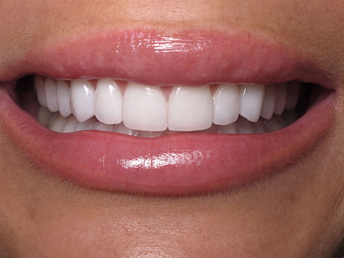 Smile Makeover Closeups Before & After Gallery - Patient 186106842 - Image 2