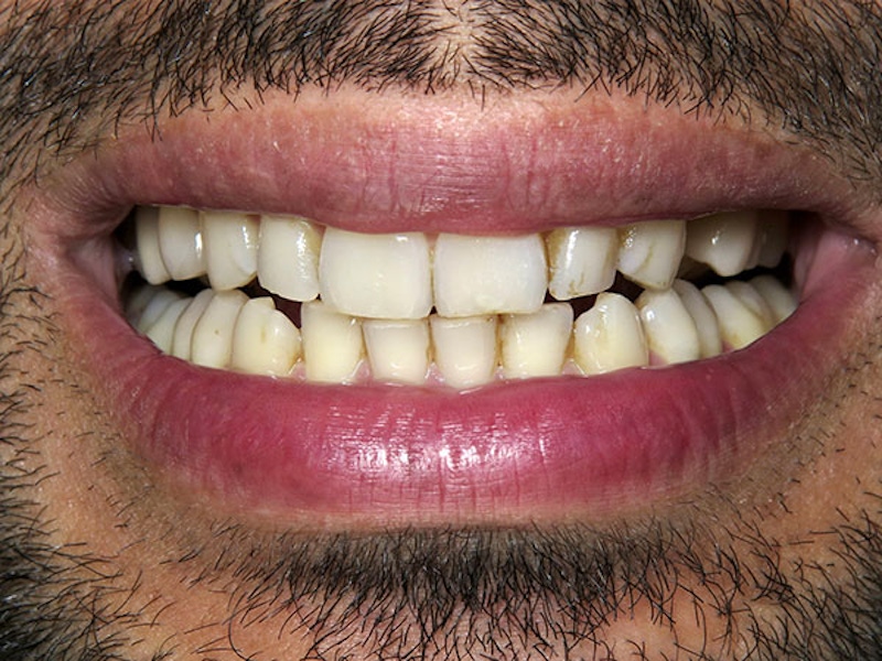 Smile Makeover Closeups Before & After Gallery - Patient 186106843 - Image 1