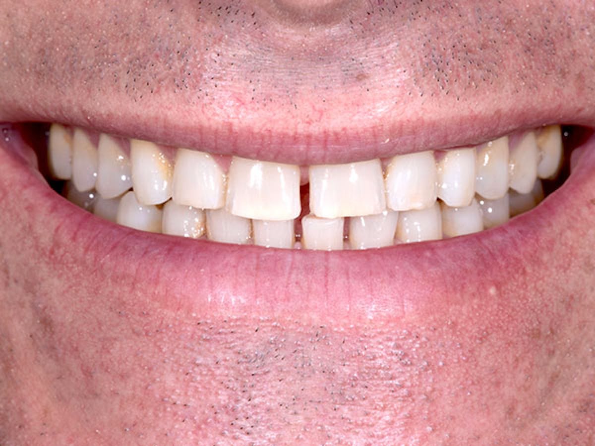 Smile Makeover Closeups Before & After Gallery - Patient 186106844 - Image 1
