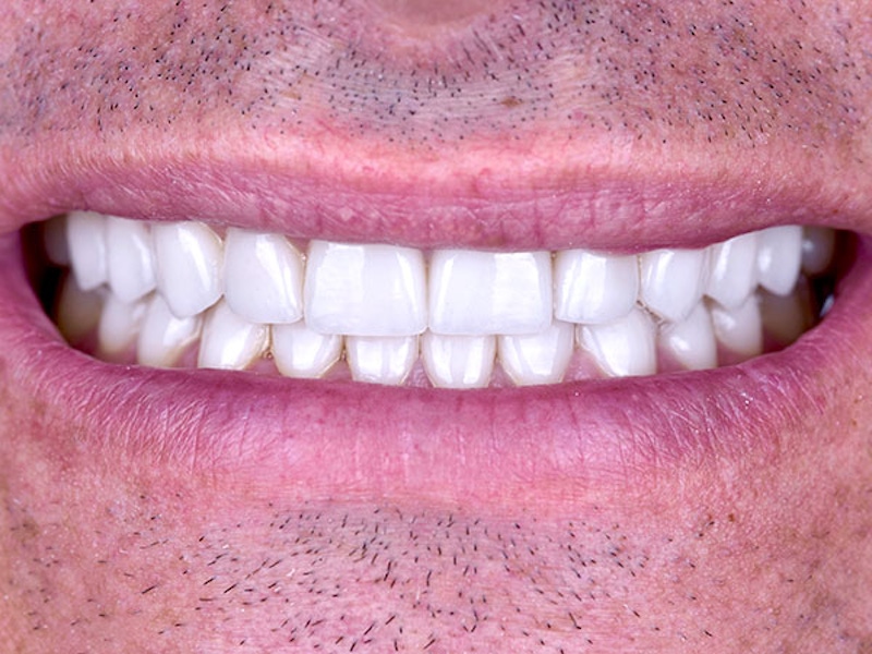 Smile Makeover Closeups Before & After Gallery - Patient 186106844 - Image 2