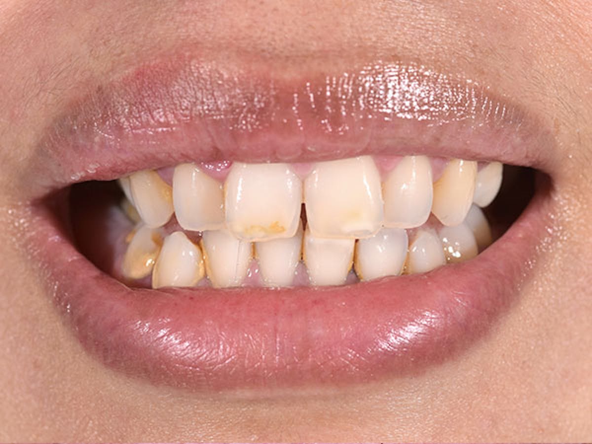 Smile Makeover Closeups Before & After Gallery - Patient 186106845 - Image 1