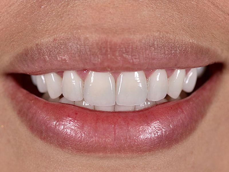 Smile Makeover Closeups Before & After Gallery - Patient 186106845 - Image 2