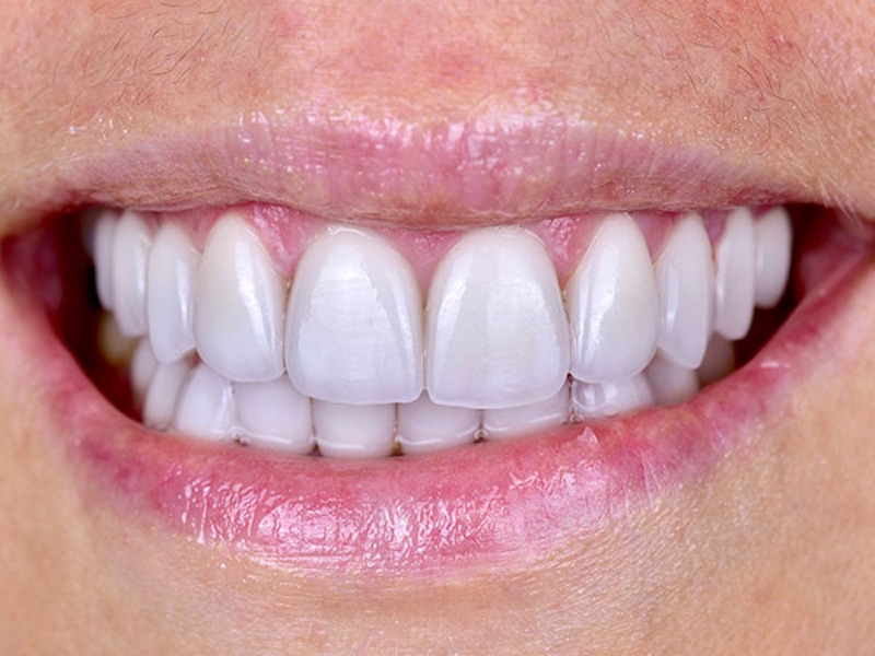 Smile Makeover Closeups Before & After Gallery - Patient 186106846 - Image 2