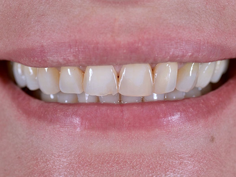 Smile Makeover Closeups Before & After Gallery - Patient 186106847 - Image 1