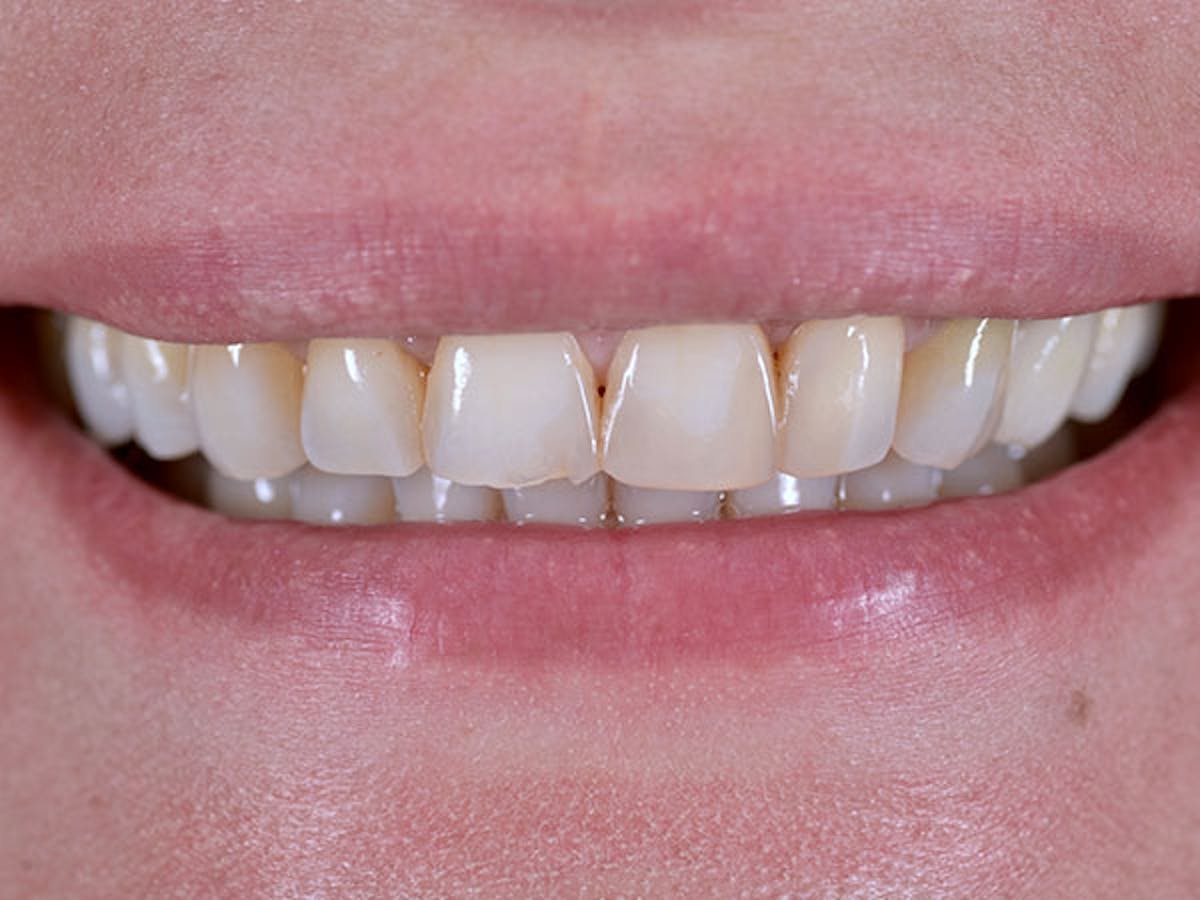 Smile Makeover Closeups Before & After Gallery - Patient 186106847 - Image 1