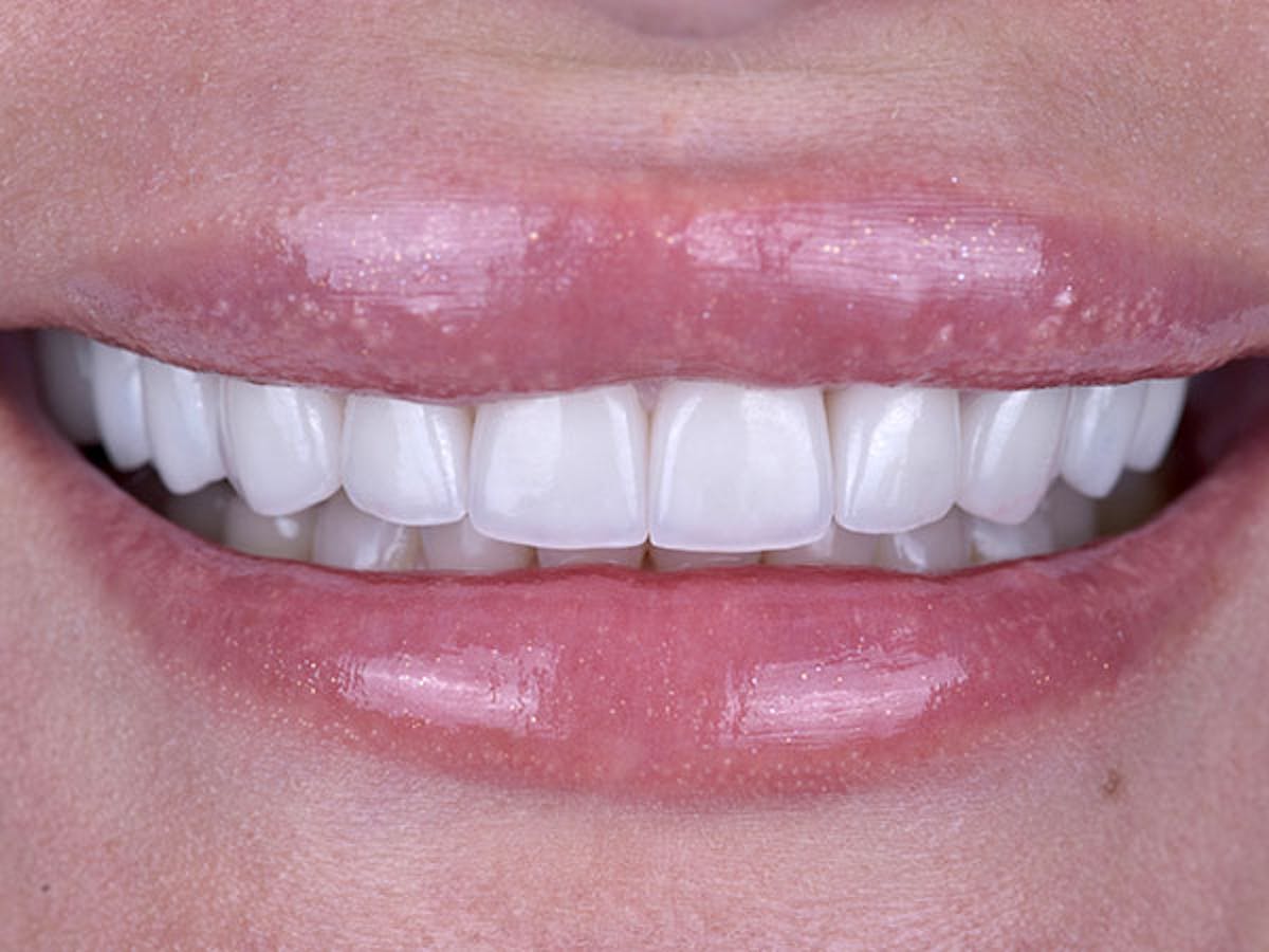 Smile Makeover Closeups Before & After Gallery - Patient 186106847 - Image 2