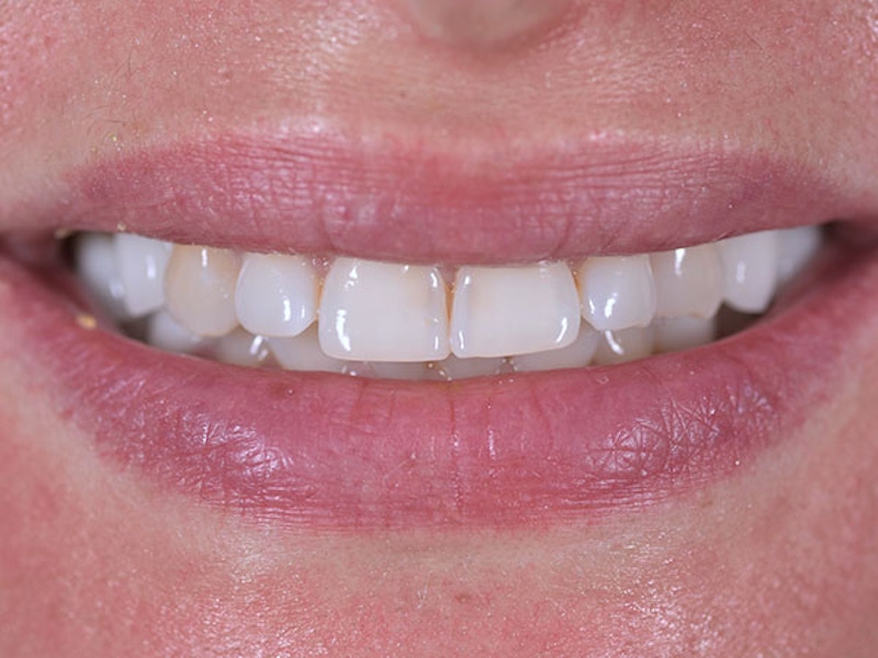 Smile Makeover Closeups Before & After Gallery - Patient 186106848 - Image 1