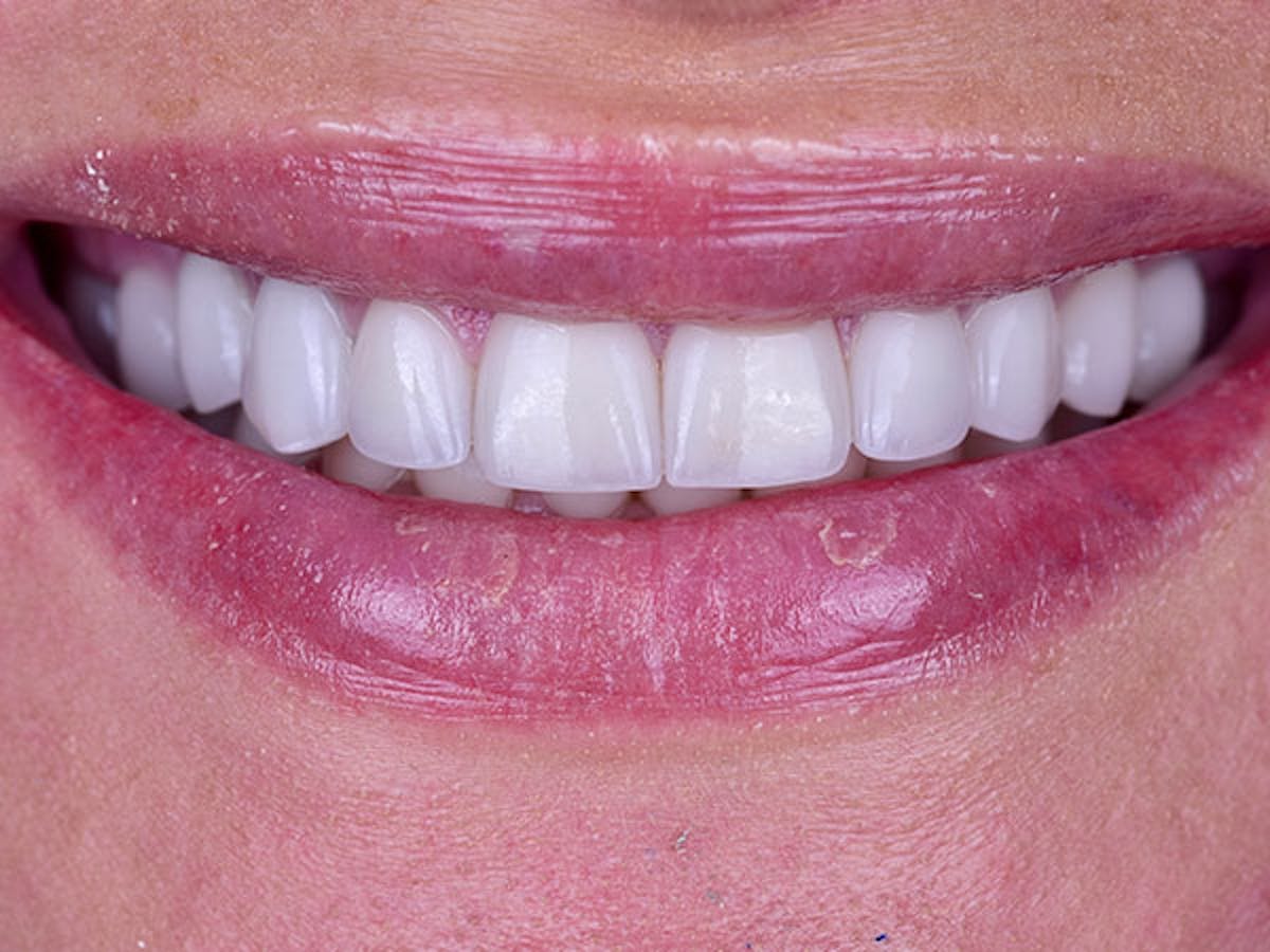 Smile Makeover Closeups Before & After Gallery - Patient 186106848 - Image 2